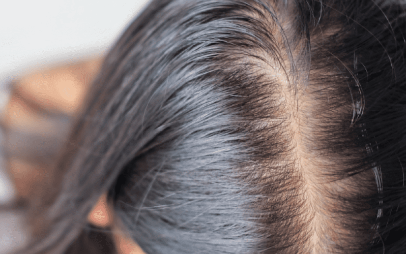 haarausfall pcos